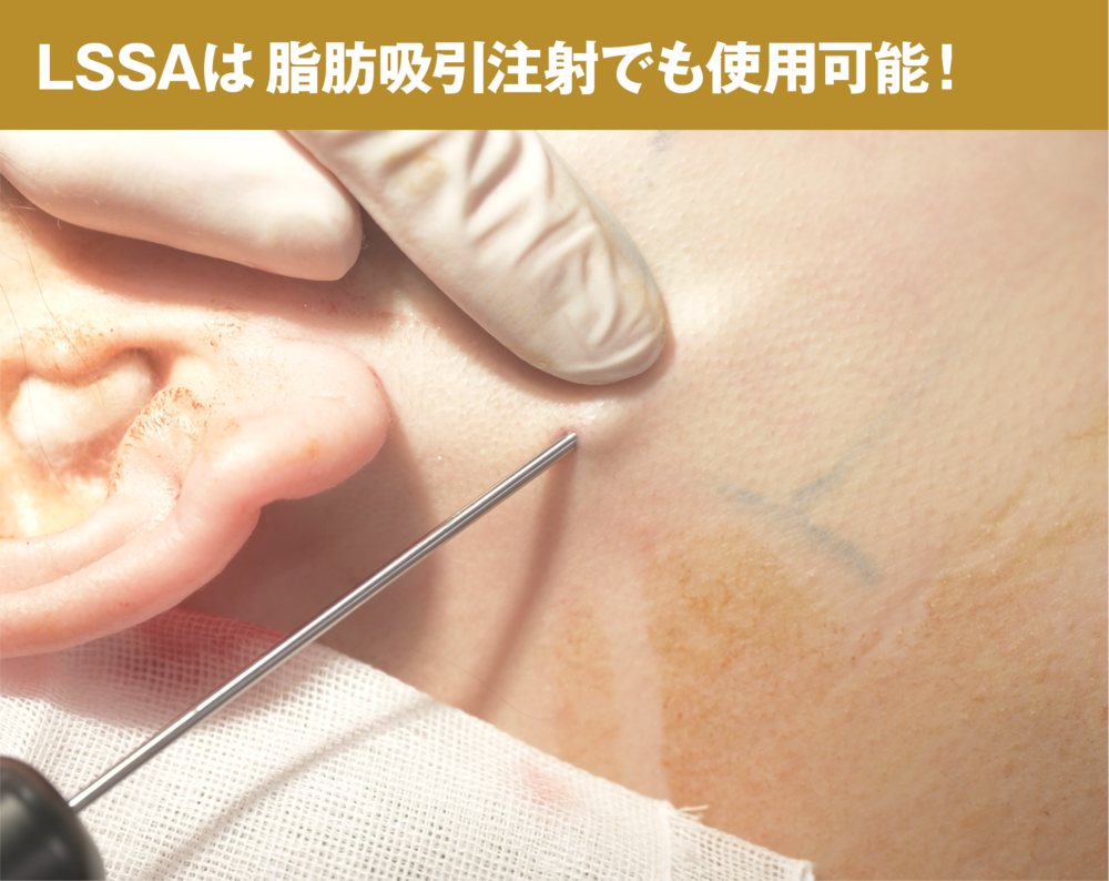 LSSA(エルサ)は脂肪吸引注射でも使用可能