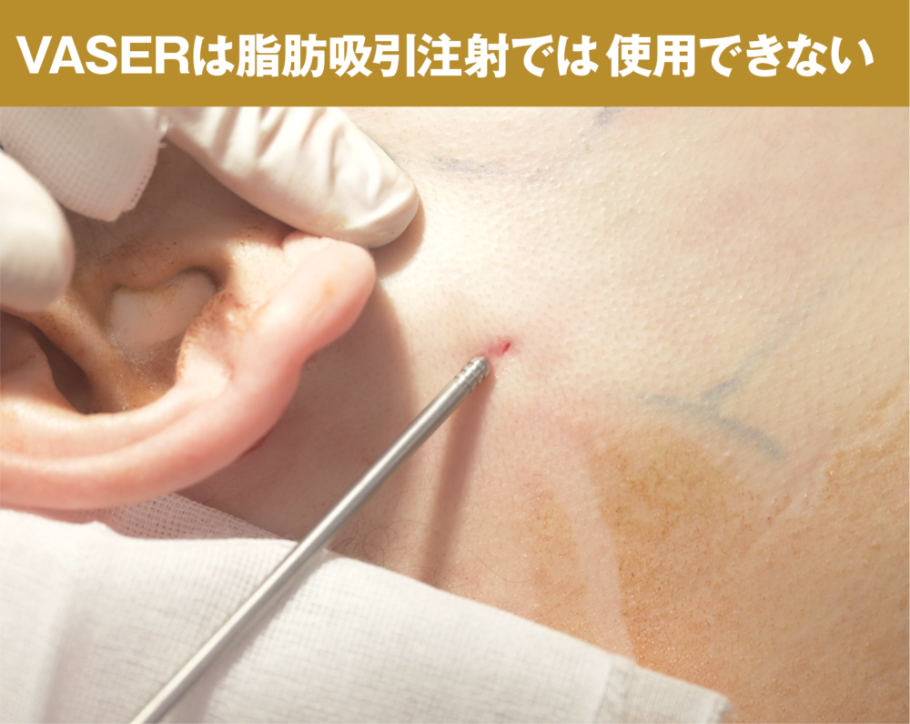 Vaser(ベイザー)は脂肪吸引注射では使用不可