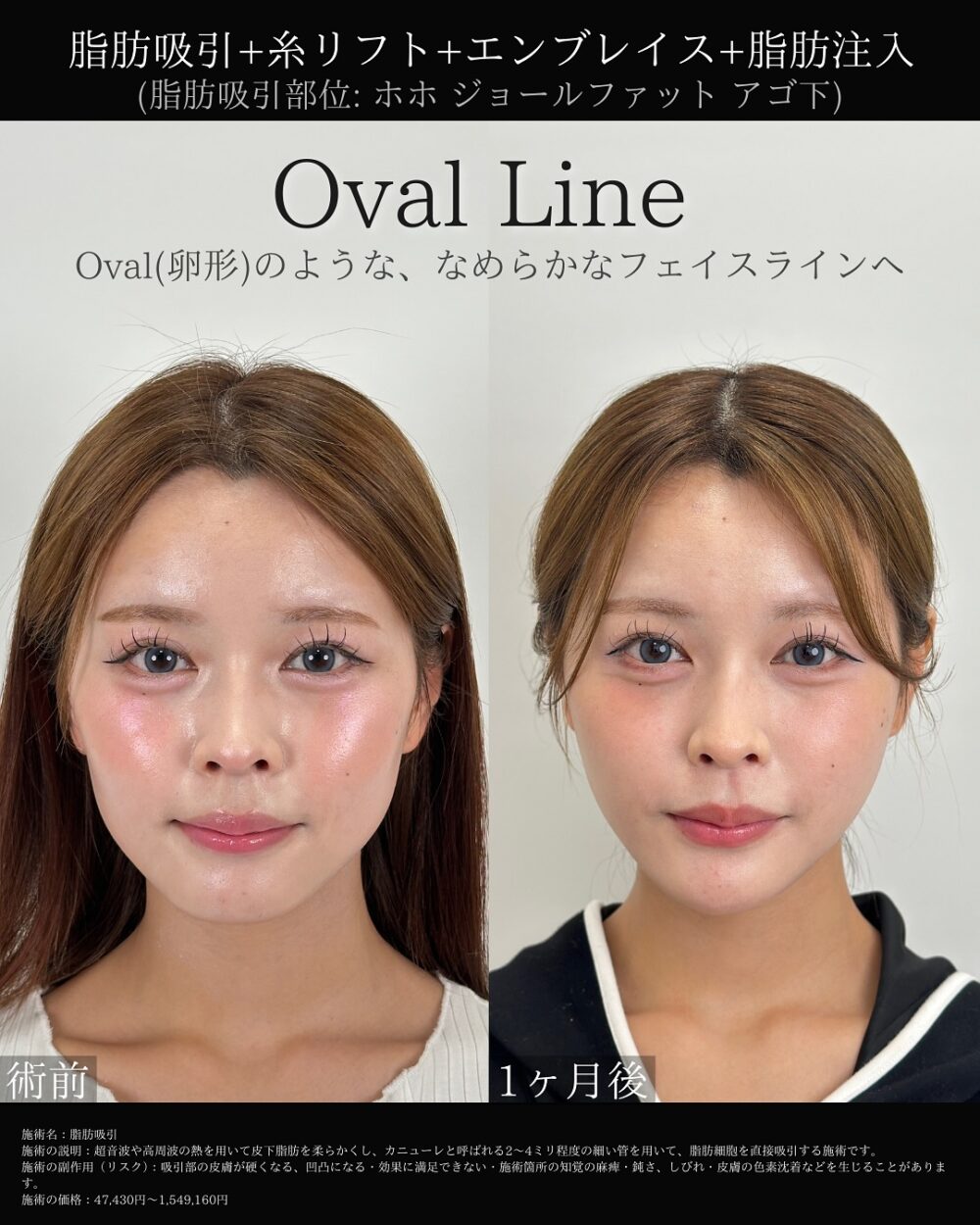 脂肪注入の症例写真
