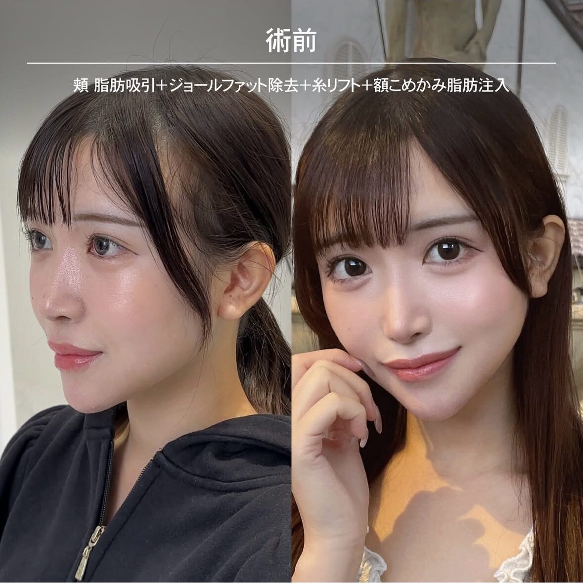 顔の脂肪注入のダウンタイム症例 術前