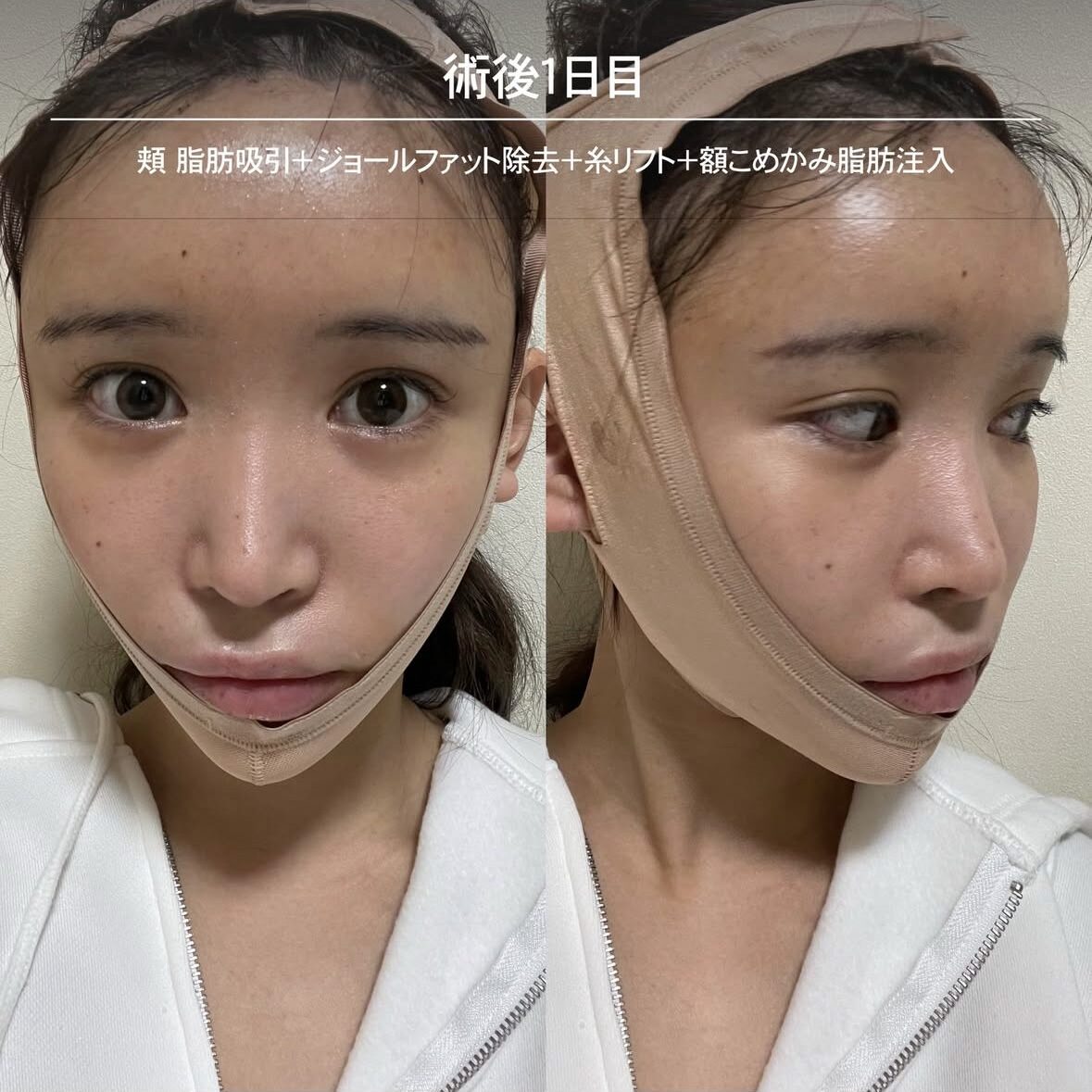 顔の脂肪注入のダウンタイム症例 術後1日目