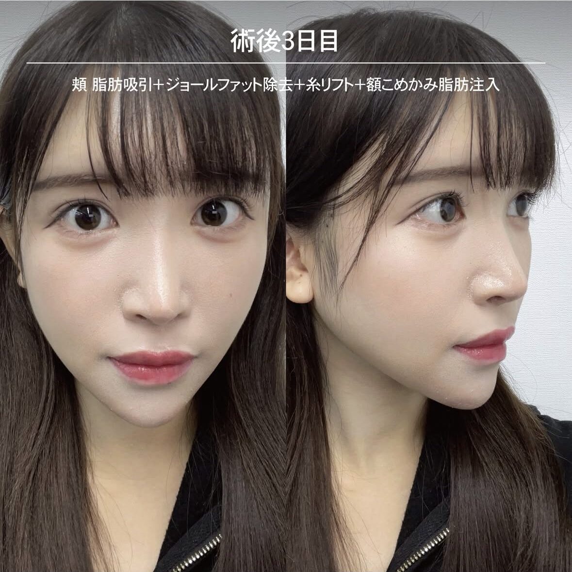 顔の脂肪注入のダウンタイム症例 術後3日目