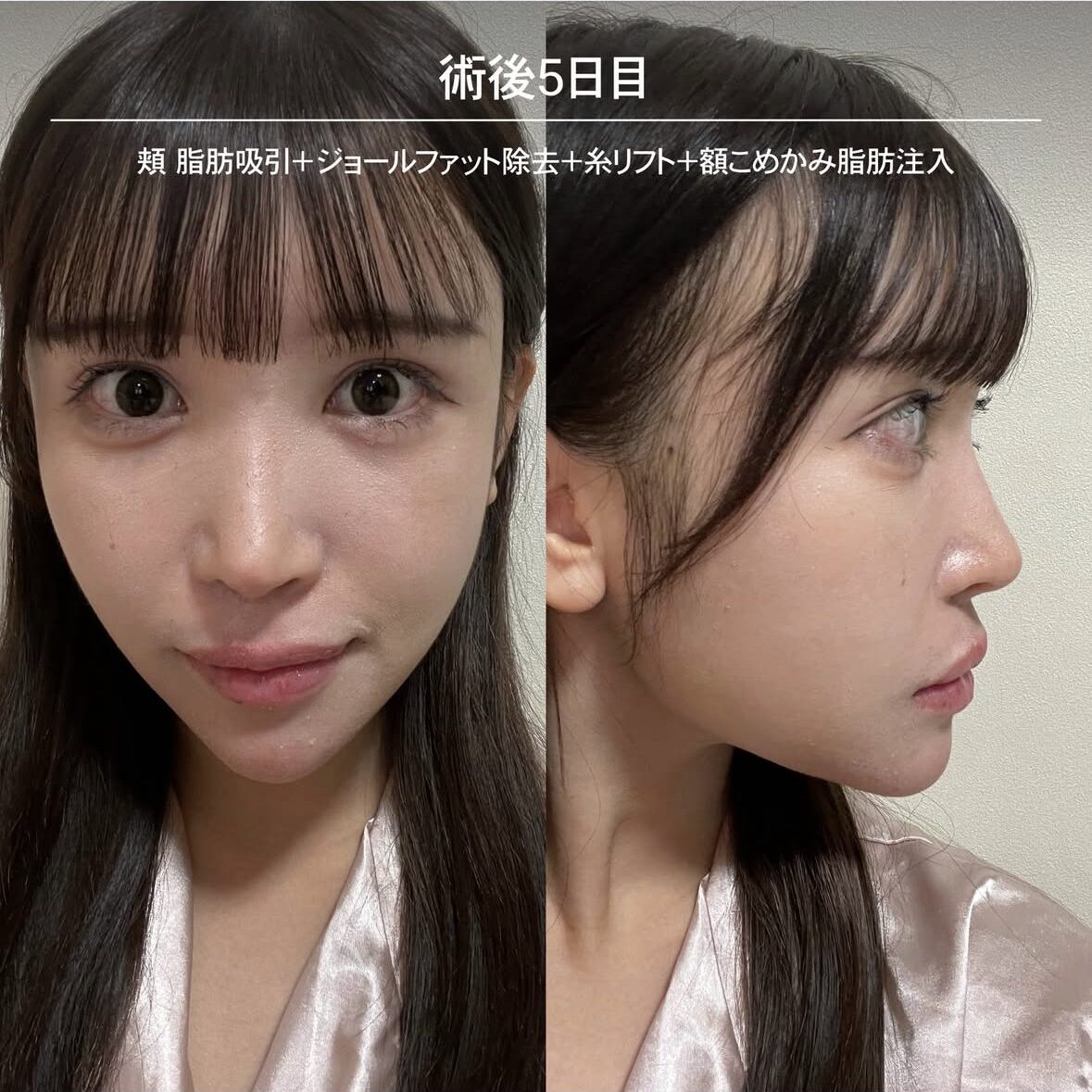 顔の脂肪注入のダウンタイム症例 術後5日目