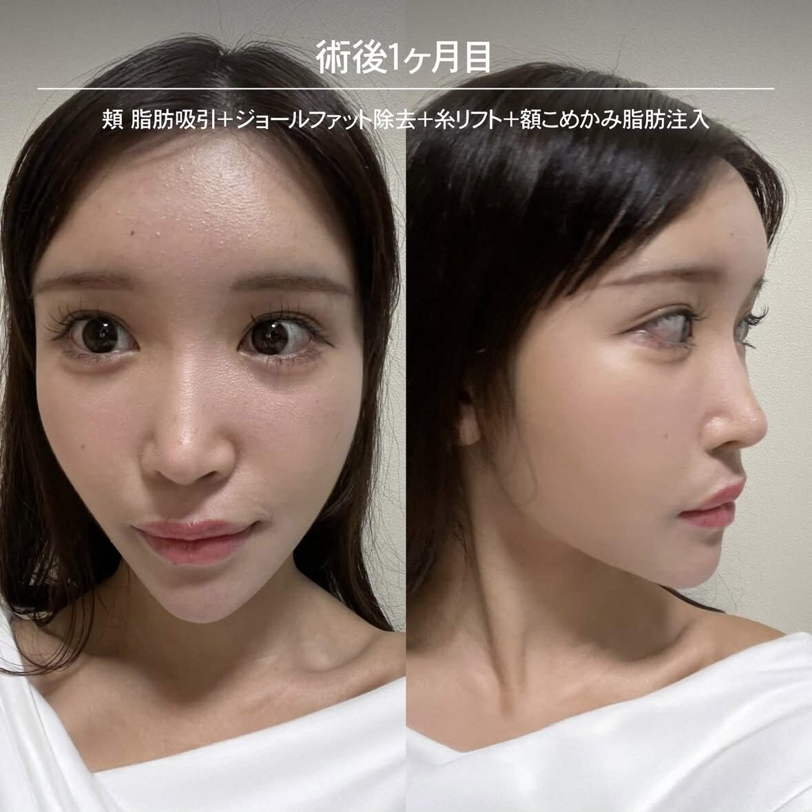 顔の脂肪注入のダウンタイム症例 術後1ヶ月目