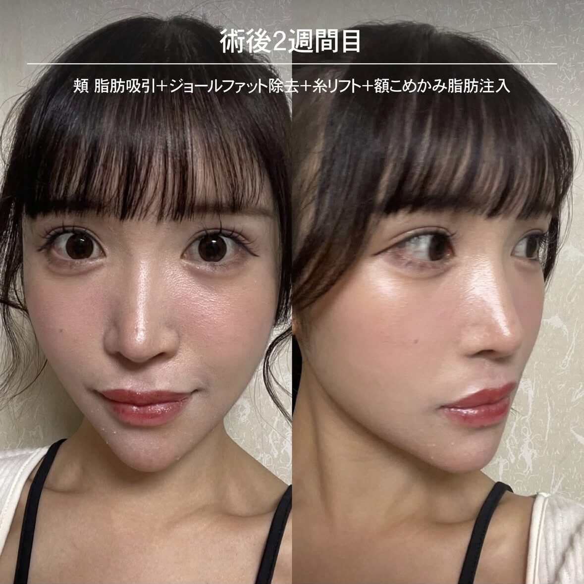 顔の脂肪注入のダウンタイム症例 術後2週間目