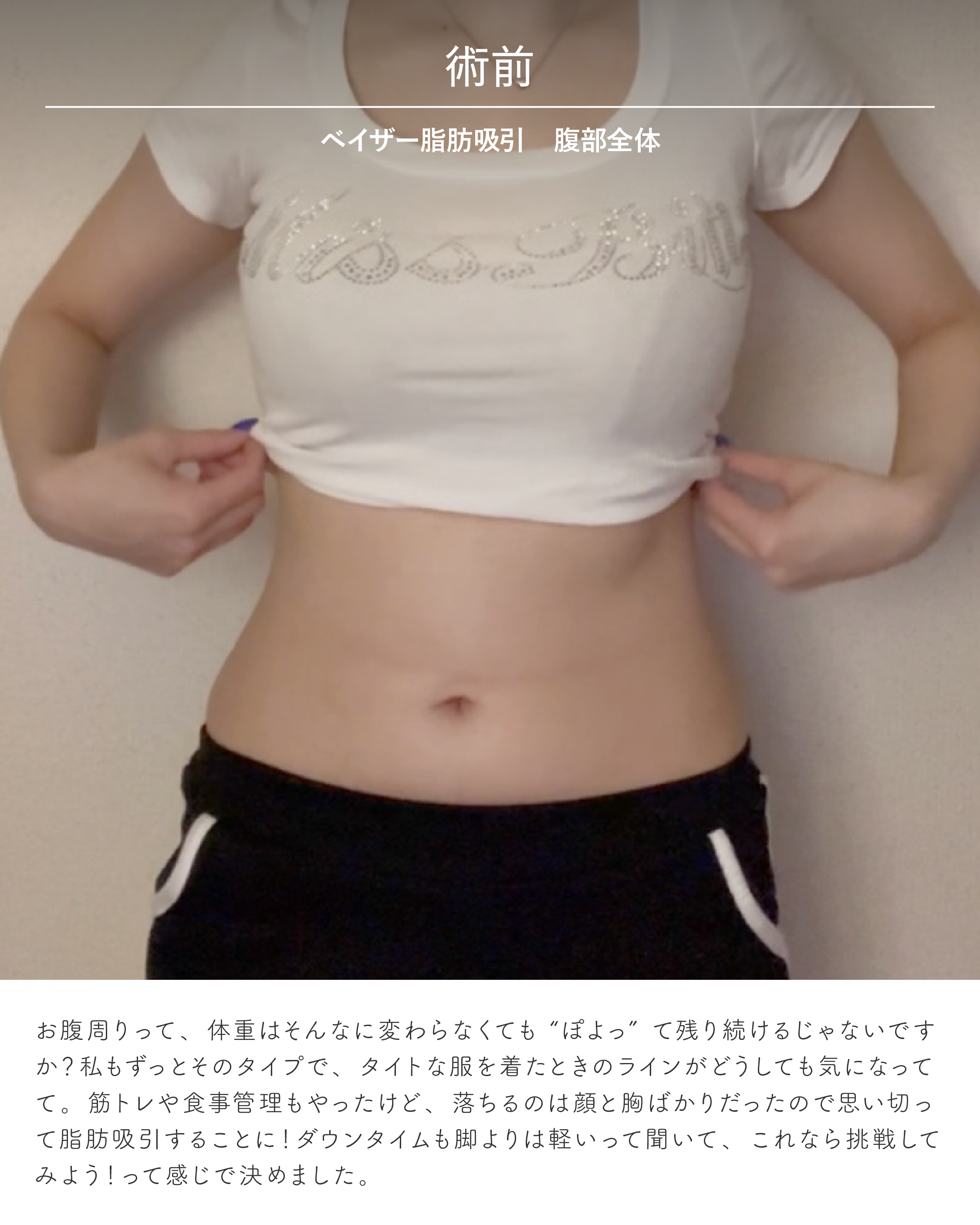 お腹脂肪吸引の症例写真 術前