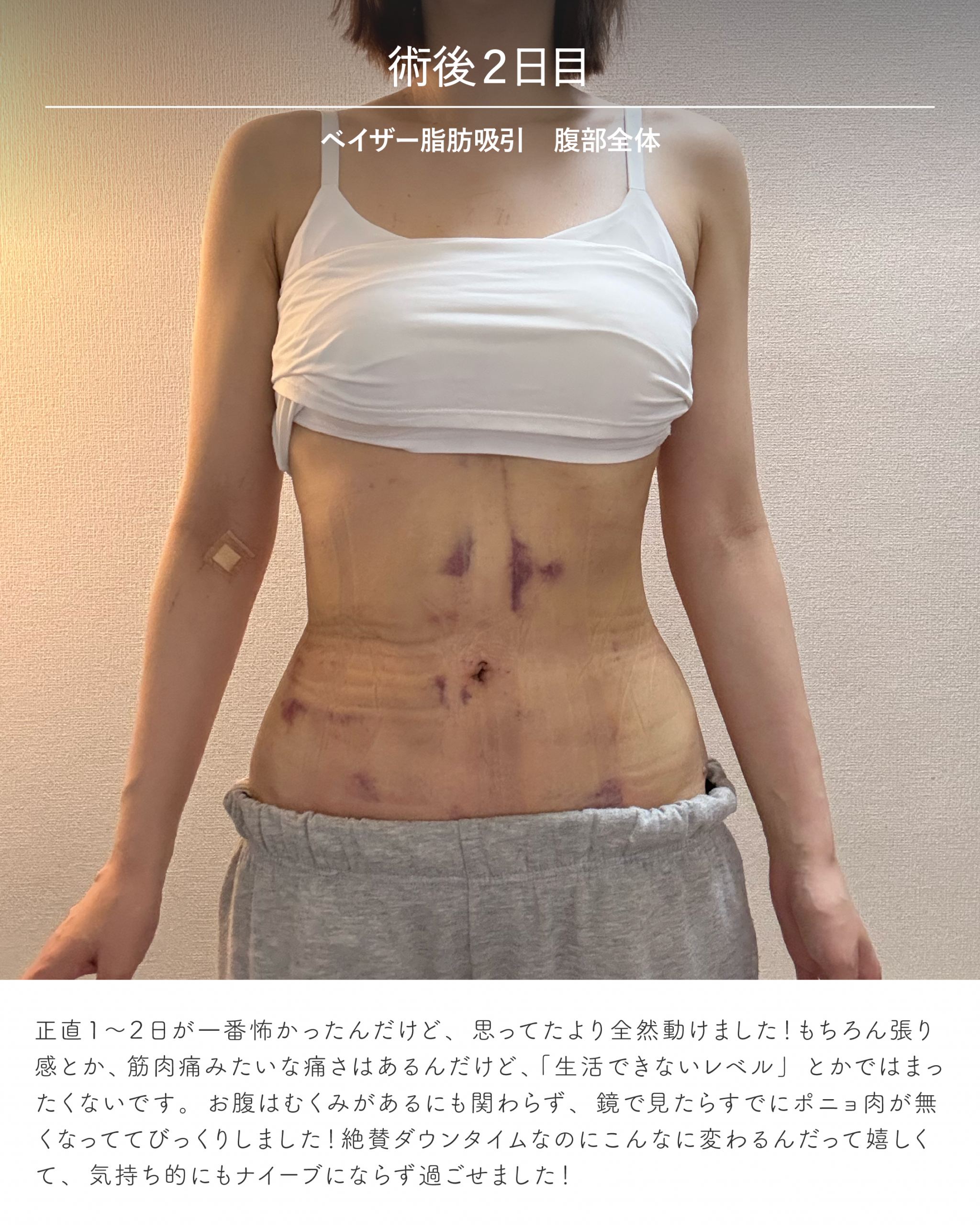 お腹脂肪吸引のダウンタイム経過 術後2日目