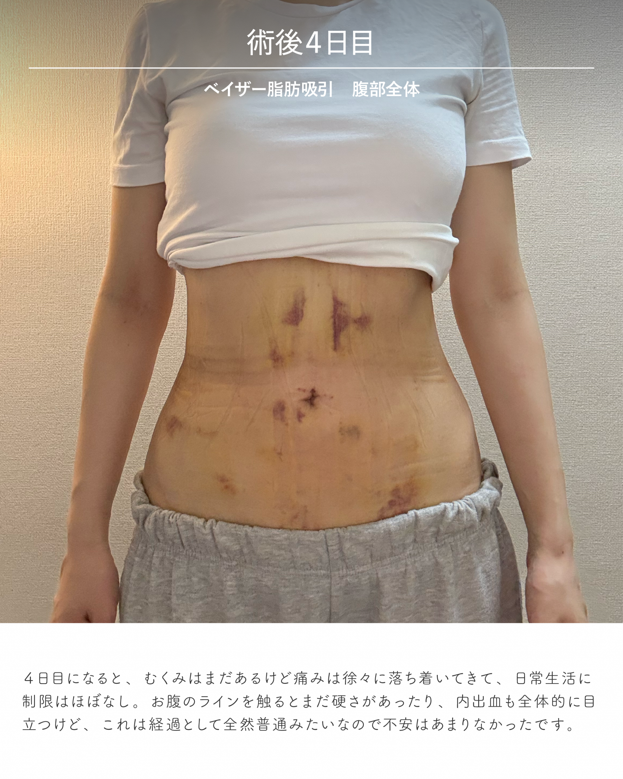 お腹脂肪吸引のダウンタイム経過 術後4日目