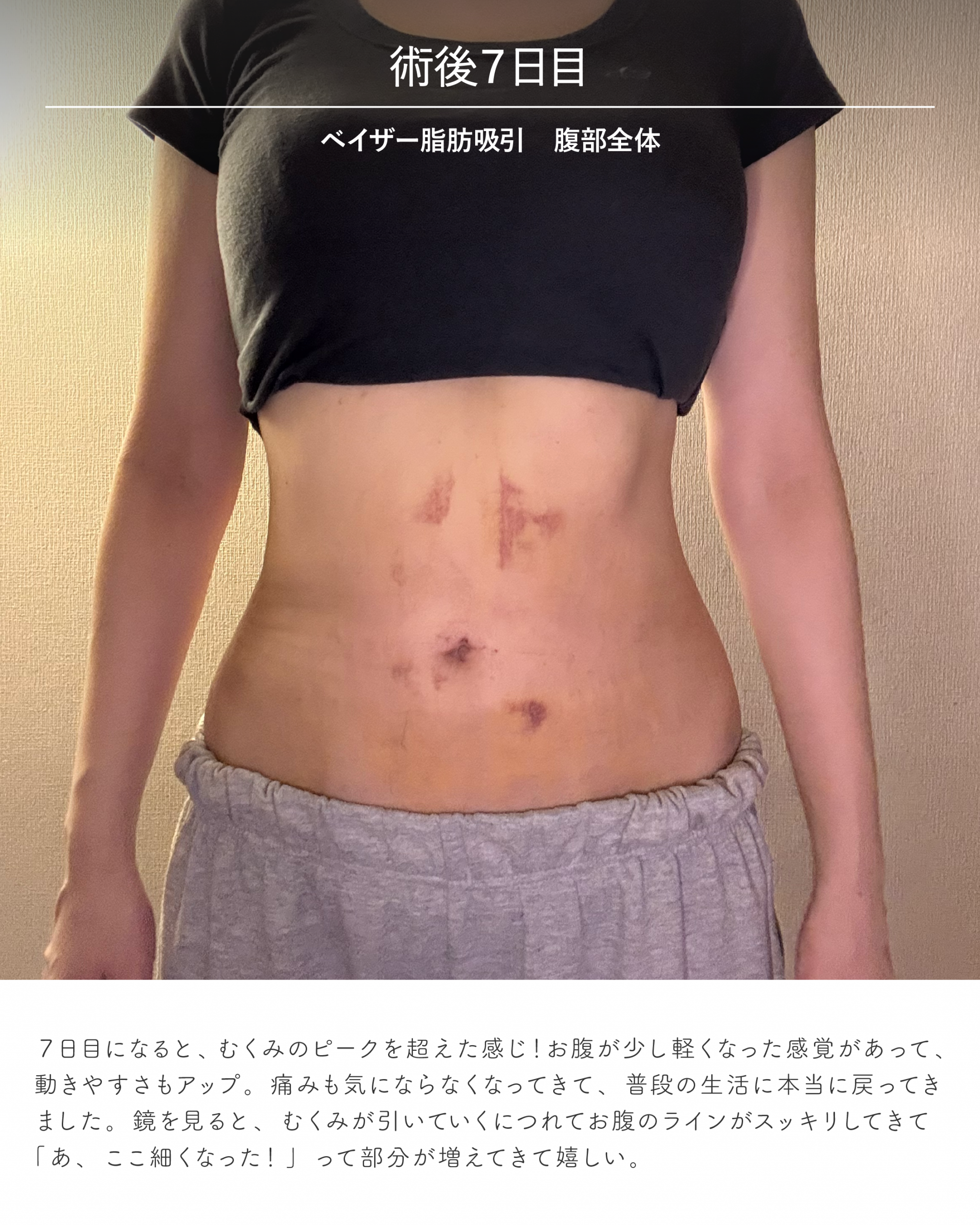 お腹脂肪吸引のダウンタイム経過 術後7日目