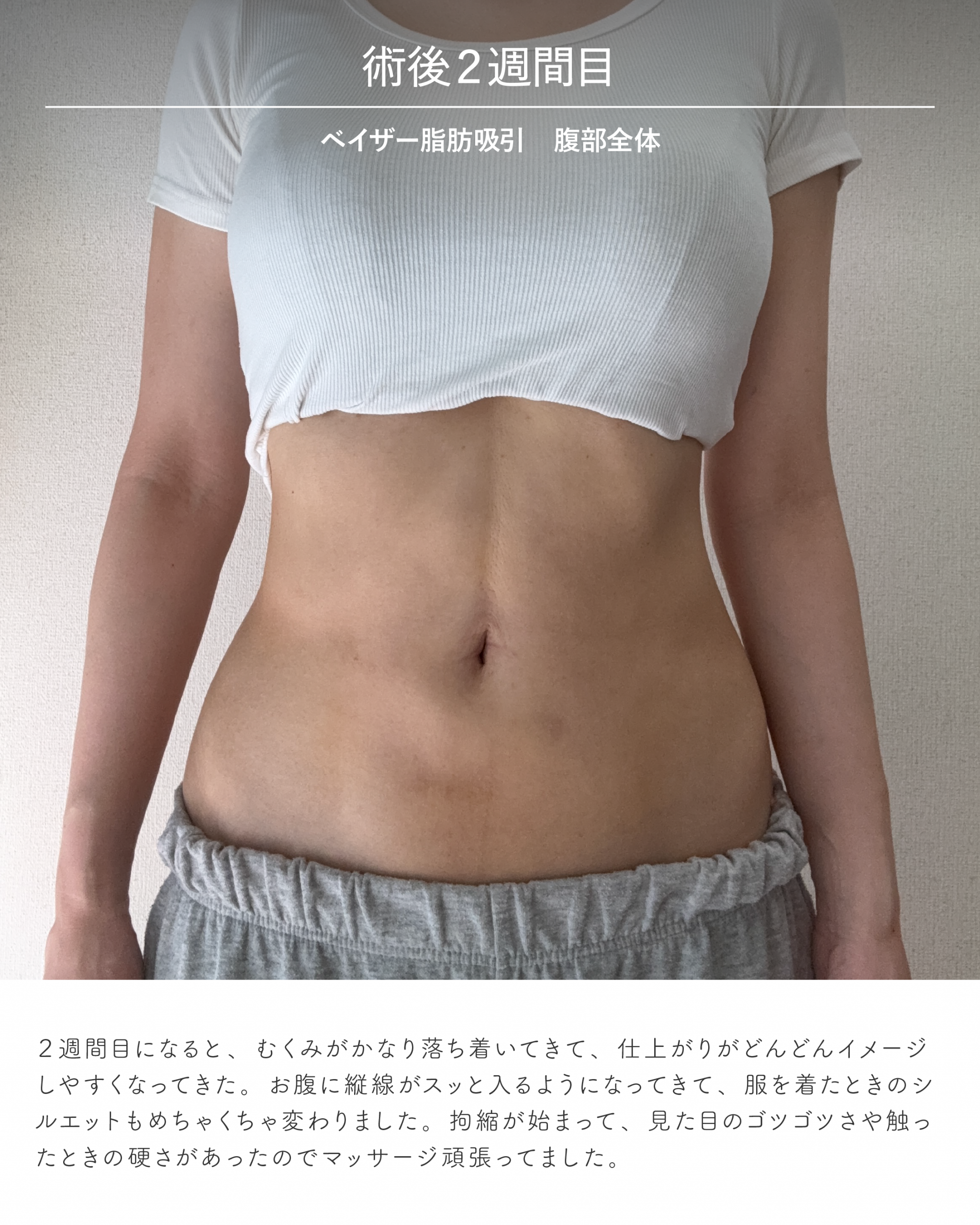 お腹脂肪吸引のダウンタイム経過 術後2週間目
