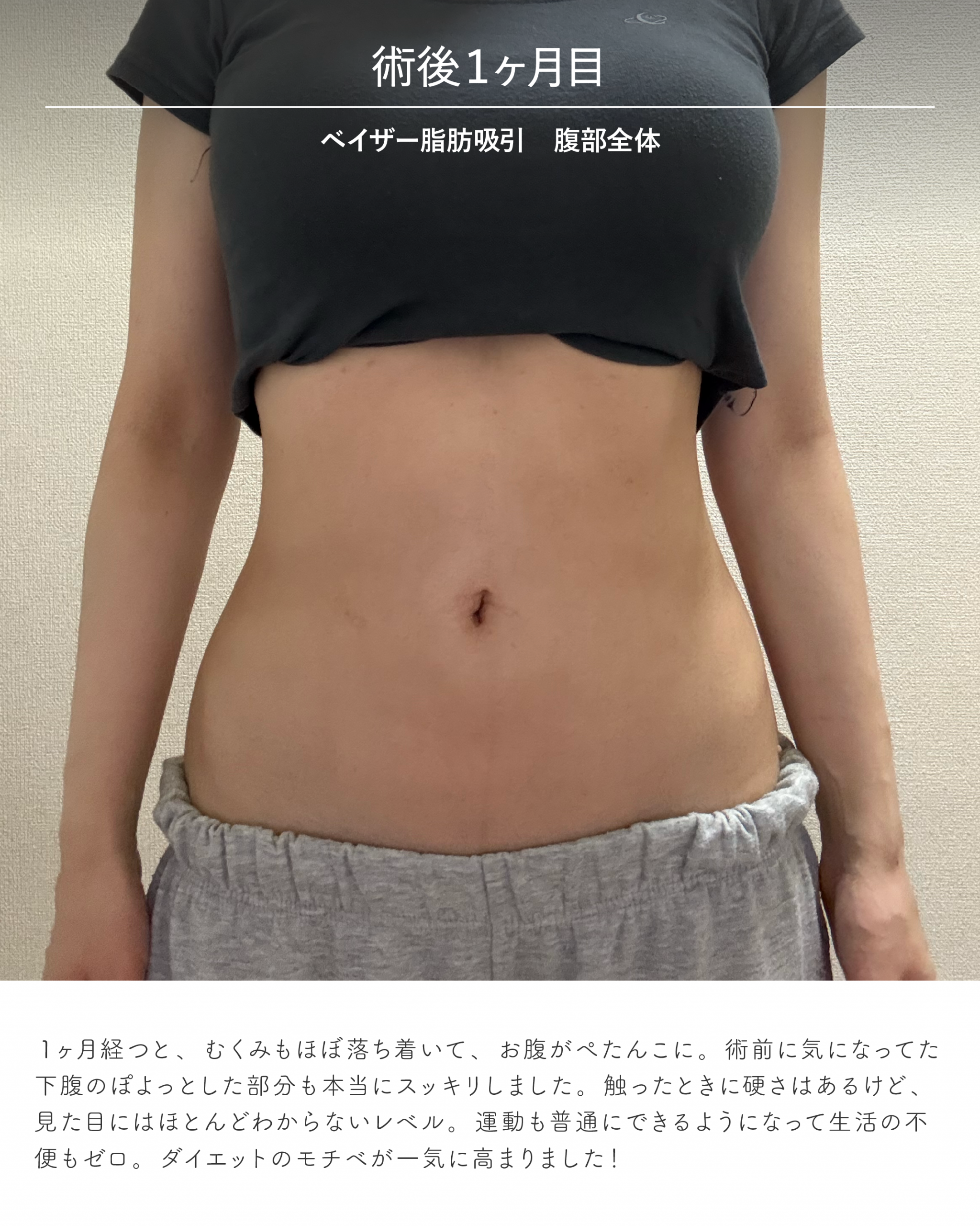 お腹脂肪吸引のダウンタイム経過 術後1ヶ月目