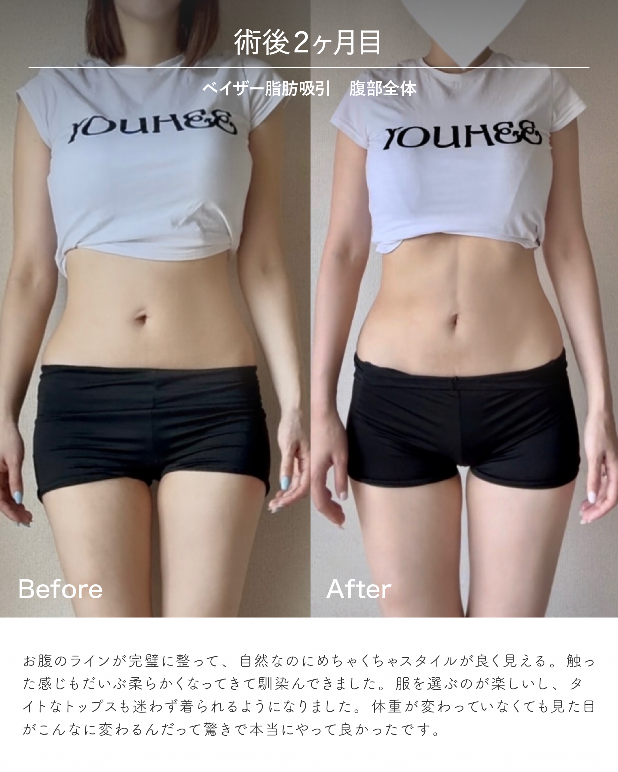 お腹脂肪吸引のダウンタイム経過 術後2ヶ月目のビフォーアフター