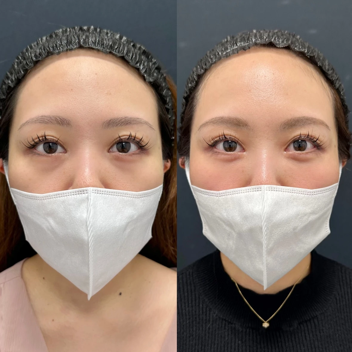 Before/After